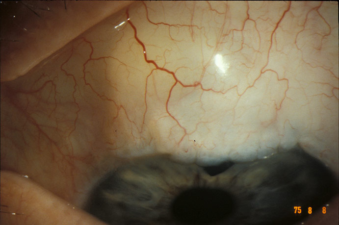 Beim Grünen Star wird im oberen Teil des Auges operativ ein künstlicher Abfluss aus dem Auge geschaffen.